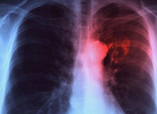 Red TBS e Inidress, juntos por un Plan Nacional de Prevención y Control de la Tuberculosis