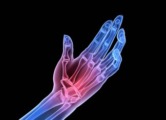 Los anti-CarP, posibles marcadores para el diagnóstico precoz de la AR