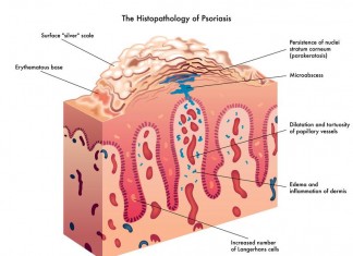 Un estudio muestra que cada euro invertido en el abordaje de la psoriasis puede tener un retorno de unos 5 euros