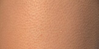 Webinar gratuito sobre la importancia del cuidado de la piel en diabéticos